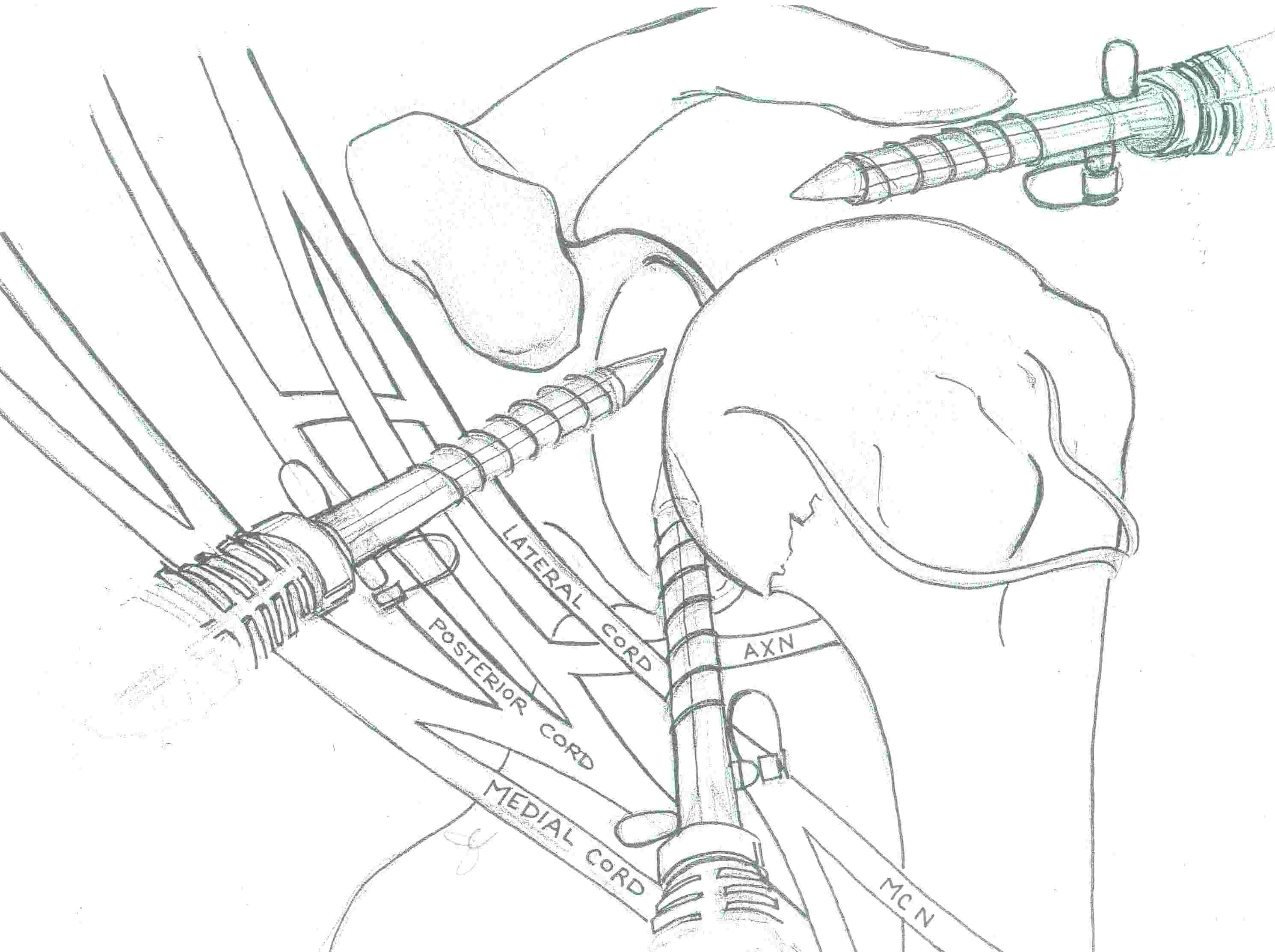 Shoulder Portals Labral Repair